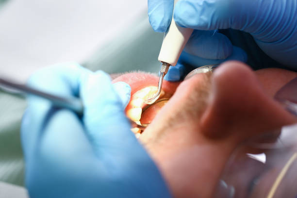 Best Emergency Wisdom Teeth Removal in Williamsport, OH