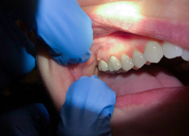Best Emergency Wisdom Teeth Removal in Williamsport, OH